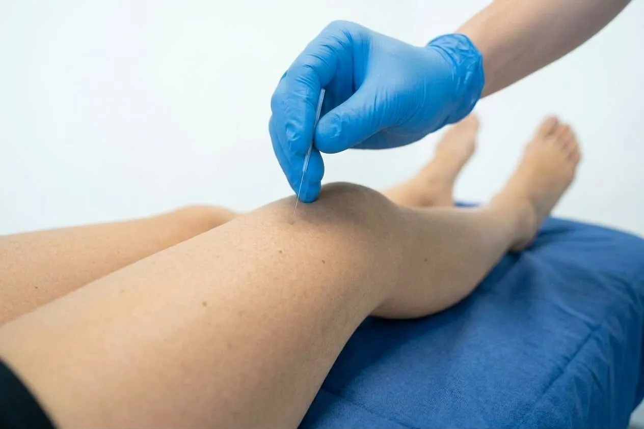 Séance de dry needling sur le genou en physiothérapie